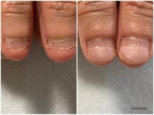 ネイルズシアム/深爪矯正