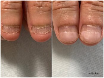 ネイルズシアム/深爪矯正