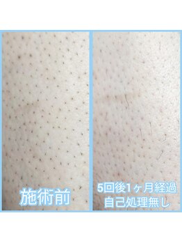 マイセルフ(myself)/足脱毛施術例：20代【拡大写真】