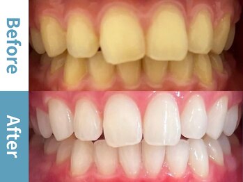 アース 岡崎店(EARTH)/【ビフォーアフター】美白