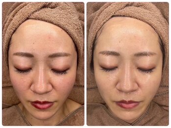 ホワイトアクア 京都店(WHITE AQUA)/ララピールでツヤ肌に/京都