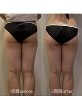 ウィール 栄 矢場町店(WE:LL)/太もも&ふくらはぎ