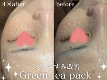 緑茶で美白/シミ/ニキビ/肌荒れケア★エイジングケアにも！
