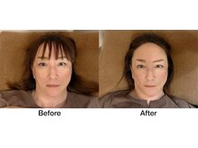 こじま 富雄団地接骨院/リフトアップ！張り感