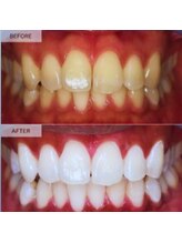 スマイルホワイト 練馬店/ホワイトニングビフォーアフター