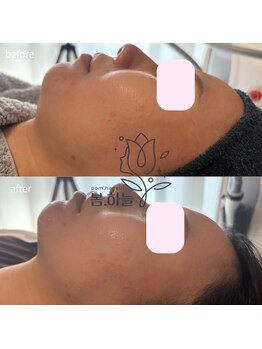 ポムハヌル 大阪梅田中崎町(pom.haneul)/マイクロ波リフト大阪