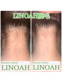 ビューティーサロン リノア(LINOAH)/◎結果重視◎【うなじ脱毛】