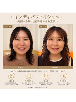 ケイビューティ(k-beauty)/速小顔コルギ/水玉リフティング