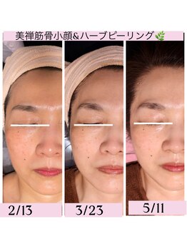 ココ 2号店(CoCo)/小顔効果症例