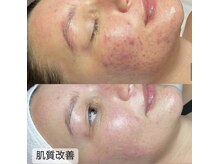 ビューティー アディクト(Beauty addict)/肌質改善