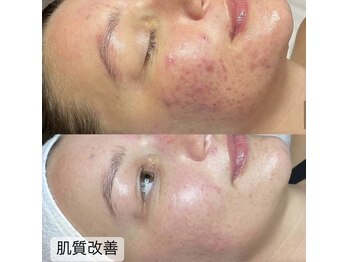 ビューティー アディクト(Beauty addict)/肌質改善