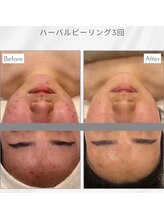 エアリアル 南行橋店/ハーブピーリングの経過