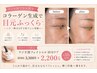 【オプション・単品不可】ラジオ波フェイシャル10分 ハリ・ニキビケア