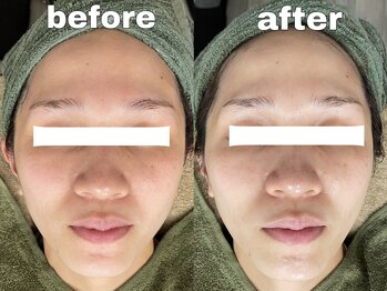 アシャ(ASHA)/翠ハーブピーリング