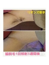リオンズ 茨城ミスターマックス取手店/【メンズ脱毛】脇1回　3週間経過