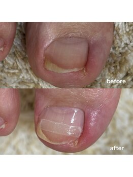 巻き爪矯正1回目（右親指）