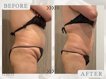 エステティックサロン ラ ベルタ(Esthetic Salon La Belta)/美骨ケア+セルライトゼロ3回