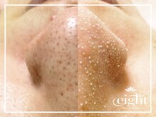 【韓国式３Ｄ毛穴洗浄】 話題の最新施術！初回限定５０％off！