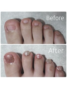 アウラ ネイル ファクトリー(aura nail factory)/フット深爪矯正スカルプ長さだし