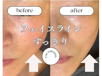 ユヌランコント 岐阜店(Une rencontre)/EMS×ラジオ波×エンビロン