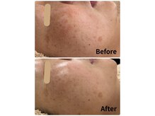 グロウスキン(GROW SKIN)/★レチノールでここまで変わる