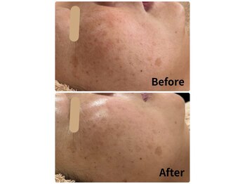 グロウスキン(GROW SKIN)/★レチノールでここまで変わる