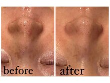 エムフルール 吹田市/毛穴洗浄before/after