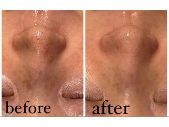 エムフルール 吹田市/毛穴洗浄before/after