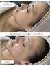 岡山希少！今話題の韓国美肌LHAピーリング！ 艶肌絶賛口コミ投稿で1000円OFF