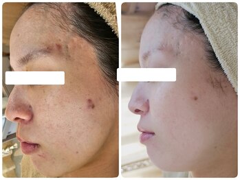 クレイルサロン(Claire salon)/本気の肌質改善ハーブピーリング