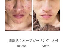 メンズミーシェ(Men's Meshie)/福井初導入ハーブピーリング