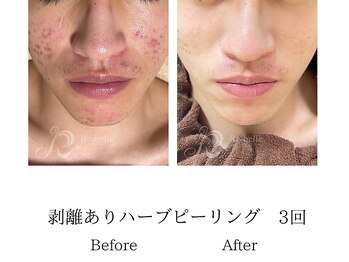 メンズミーシェ(Men's Meshie)/福井初導入ハーブピーリング