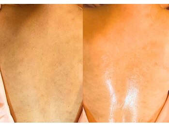 ミエリア美容鍼灸院(mielia美容鍼灸院)/鍼灸+肌質改善で背中美人