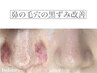 オープン記念30％OFF★美眉毛WAX＋黒ずみ毛穴改善¥20500→¥14400