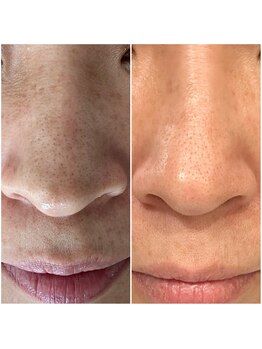 マヴィ 香里園店(MavY.)/毛穴洗浄&水光注入