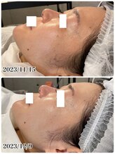 ハーシークレット(Her secret)/ハーブピーリング・くすみケア