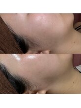 ゴールデンエイジ 吉祥寺(GOLDEN AGE)/ワックス脱毛：施術