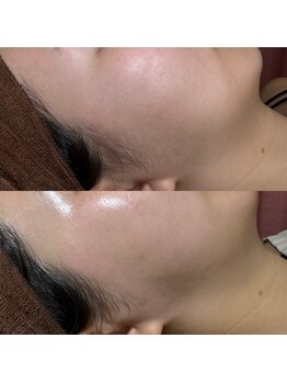 ゴールデンエイジ 吉祥寺(GOLDEN AGE)/ワックス脱毛:施術