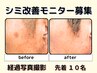 【先着10名】シミ改善モニター募集 3回分 ￥45000→￥15000 化粧品(￥14,000)