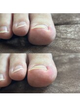 リリ(lili)/巻き爪矯正1回目（右親指）