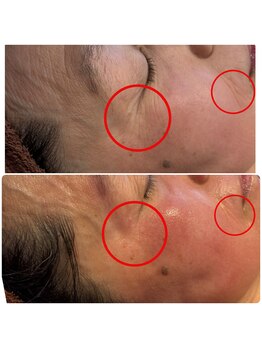 ティエット(tiet)/ハーブピーリング