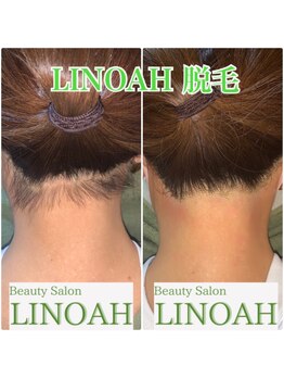 ビューティーサロン リノア(LINOAH)/◎結果重視◎【うなじ脱毛】
