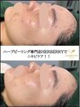 ハーバリー ハーブピーリング 金山店(HERBERRYハーブピーリング) 【剥離あり】リベルハーブピーリングはニキビケアにも効果発揮◎