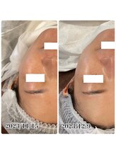 ハーシークレット(Her secret)/ハーブピーリング・くすみケア