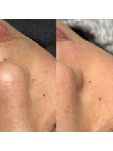 エイト(8)/フェイスWAX脱毛
