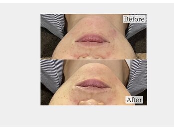 エステティック バイ マルキーズ(ESTHETIC by marquise)/40代・ハーブピーリング