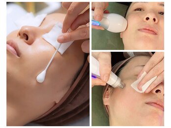 水光ピールスキン/水光ピール毛穴洗浄プラズマ