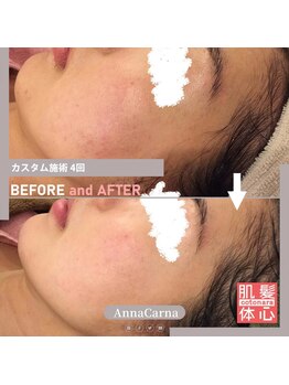 アンナカルナ(AnnaCarna)/お肌荒れ改善はエステの出番です
