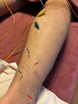 ライズ/ふくらはぎへの鍼灸