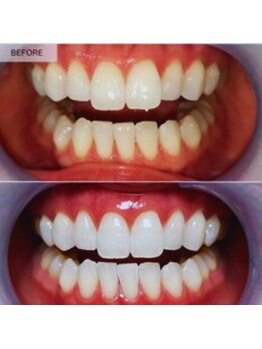 スマイルホワイト 練馬店/ホワイトニングビフォーアフター